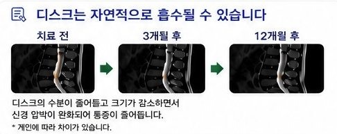디스크 자연 흡수 - 치료 전, 3개월 후, 12개월 후