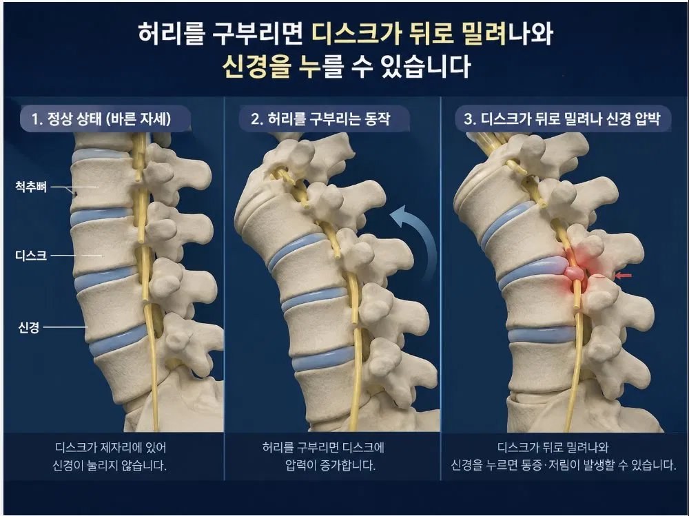 허리를 구부리면 디스크가 뒤로 밀려나와 신경을 누를 수 있습니다 - 정상 자세, 굽히는 동작, 신경 압박 3단계 비교