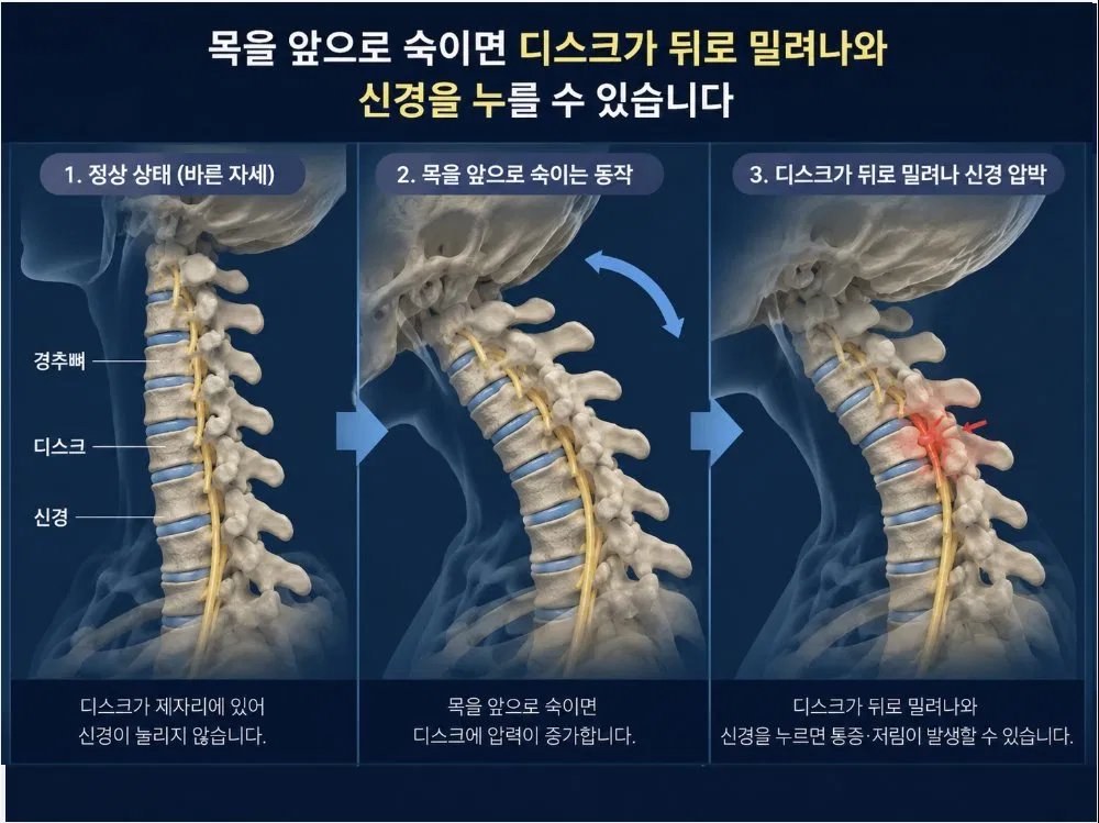 목을 앞으로 숙이면 디스크가 뒤로 밀려나와 신경을 누를 수 있습니다 - 정상 자세, 숙이는 동작, 신경 압박 3단계 비교